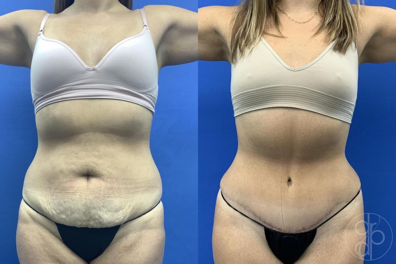 Before and after Liposuction case 30025 - Angle 2