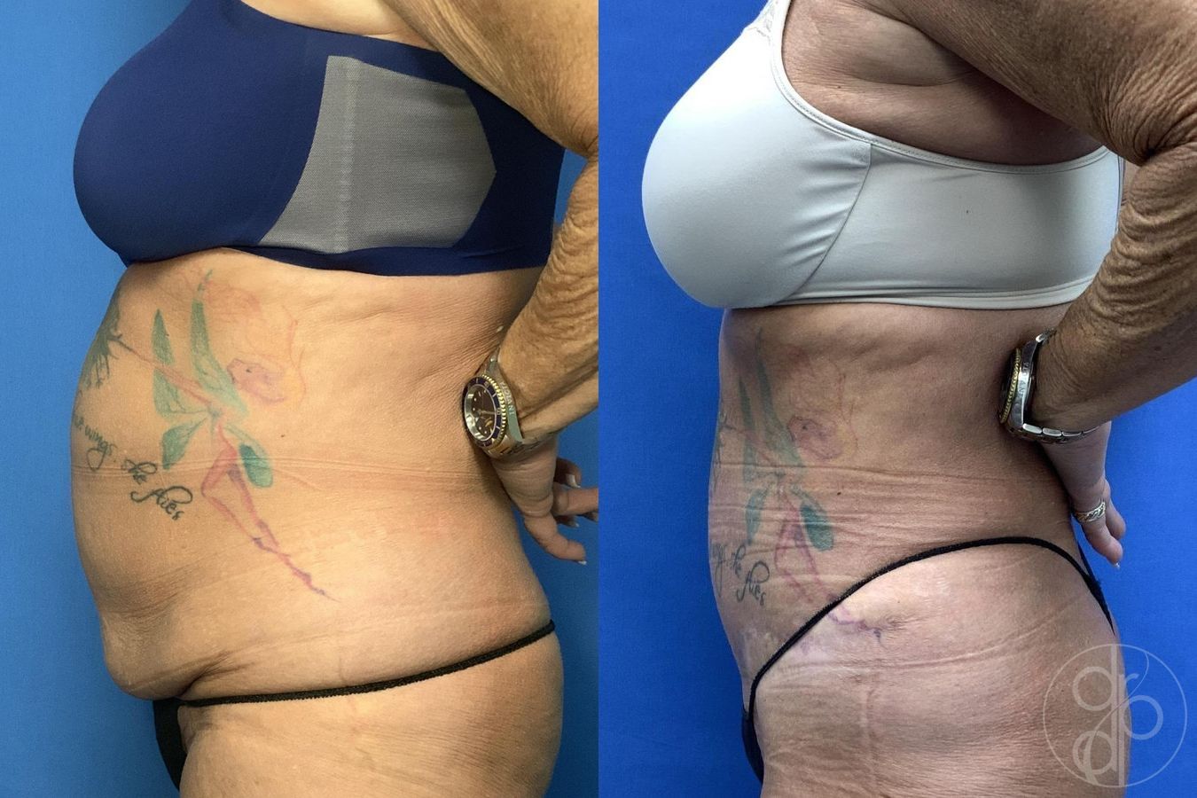Before and after Abdominoplasty case 30022 - Angle 6