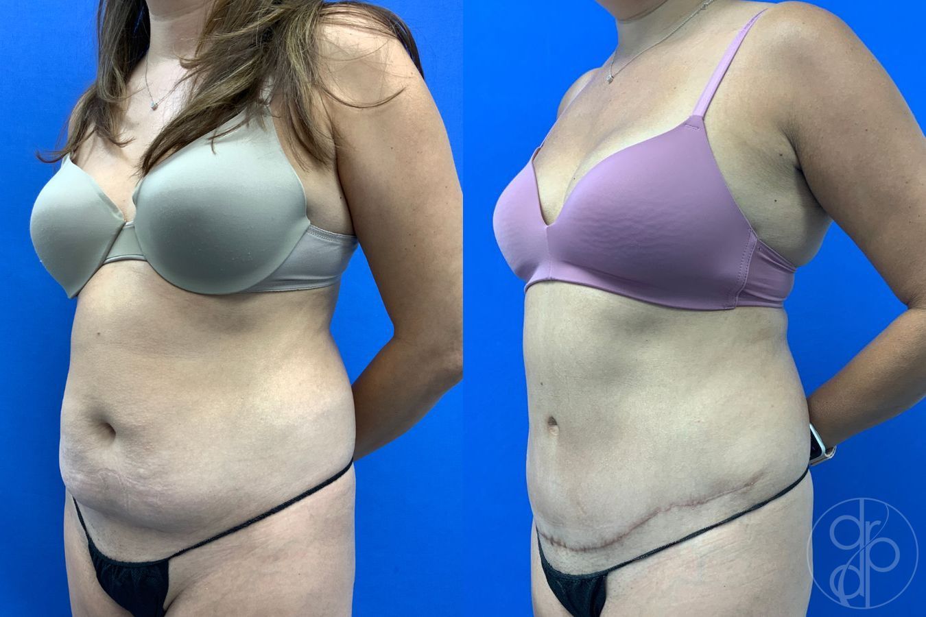 Before and after Abdominoplasty case 43451 - Angle 3