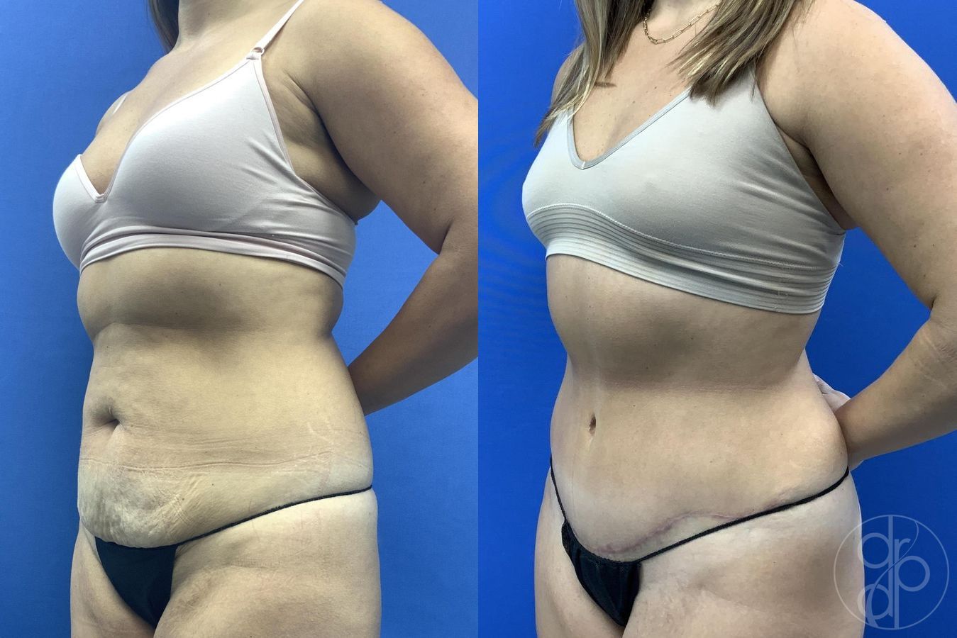 Before and after Liposuction case 30025 - Angle 3