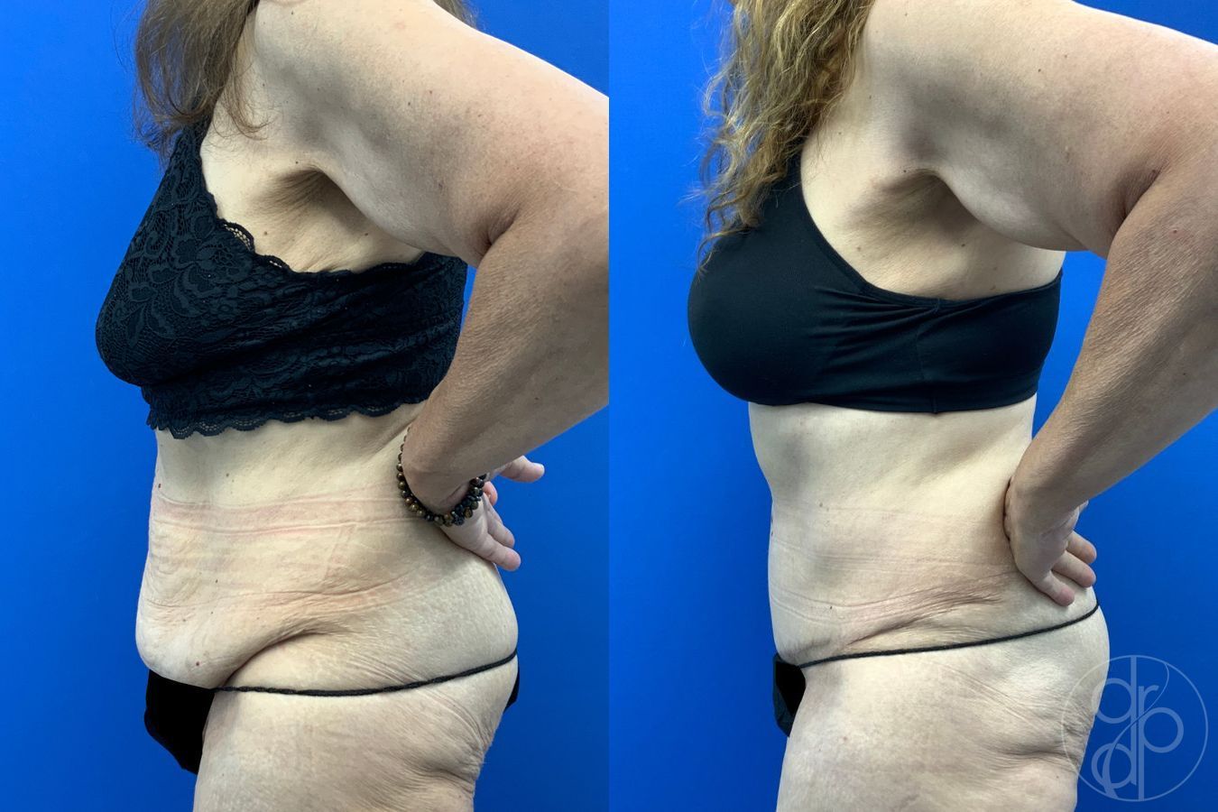 Before and after Abdominoplasty case 43198 - Angle 4
