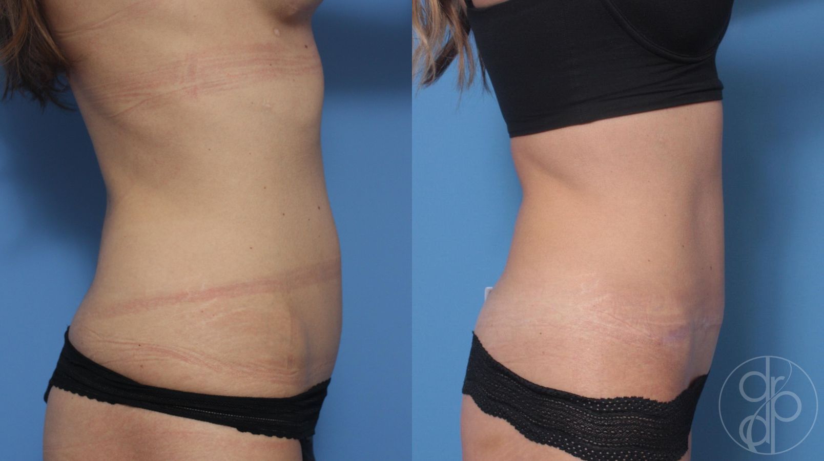 Before and after Abdominoplasty case 29522 - Angle 2