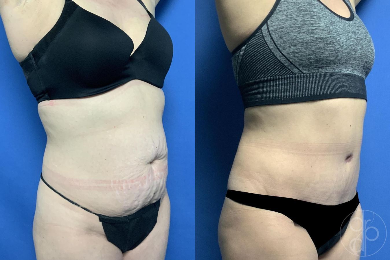 Before and after Abdominoplasty case 29563 - Angle 3