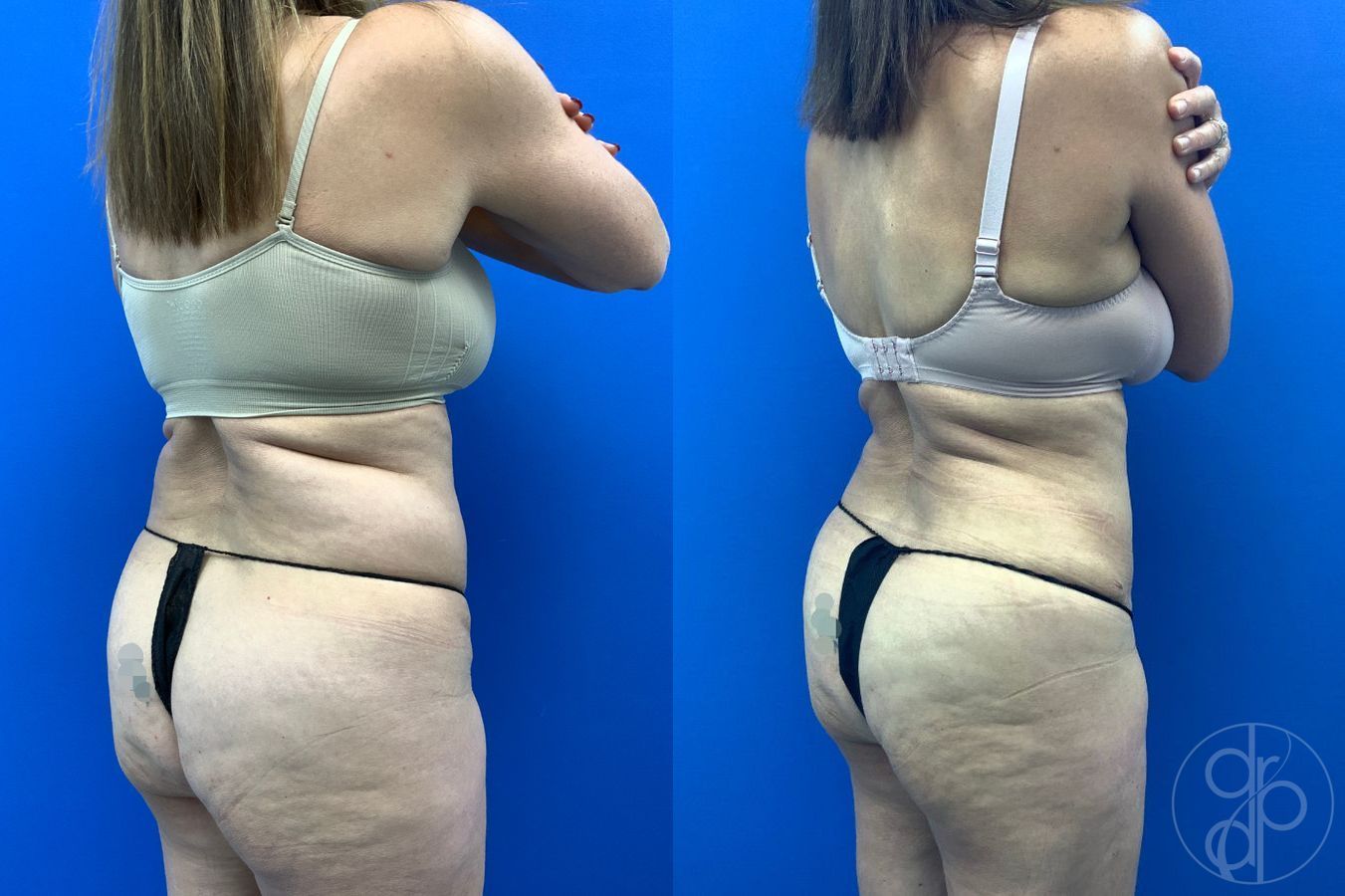 Before and after Abdominoplasty case 46404 - Angle 7