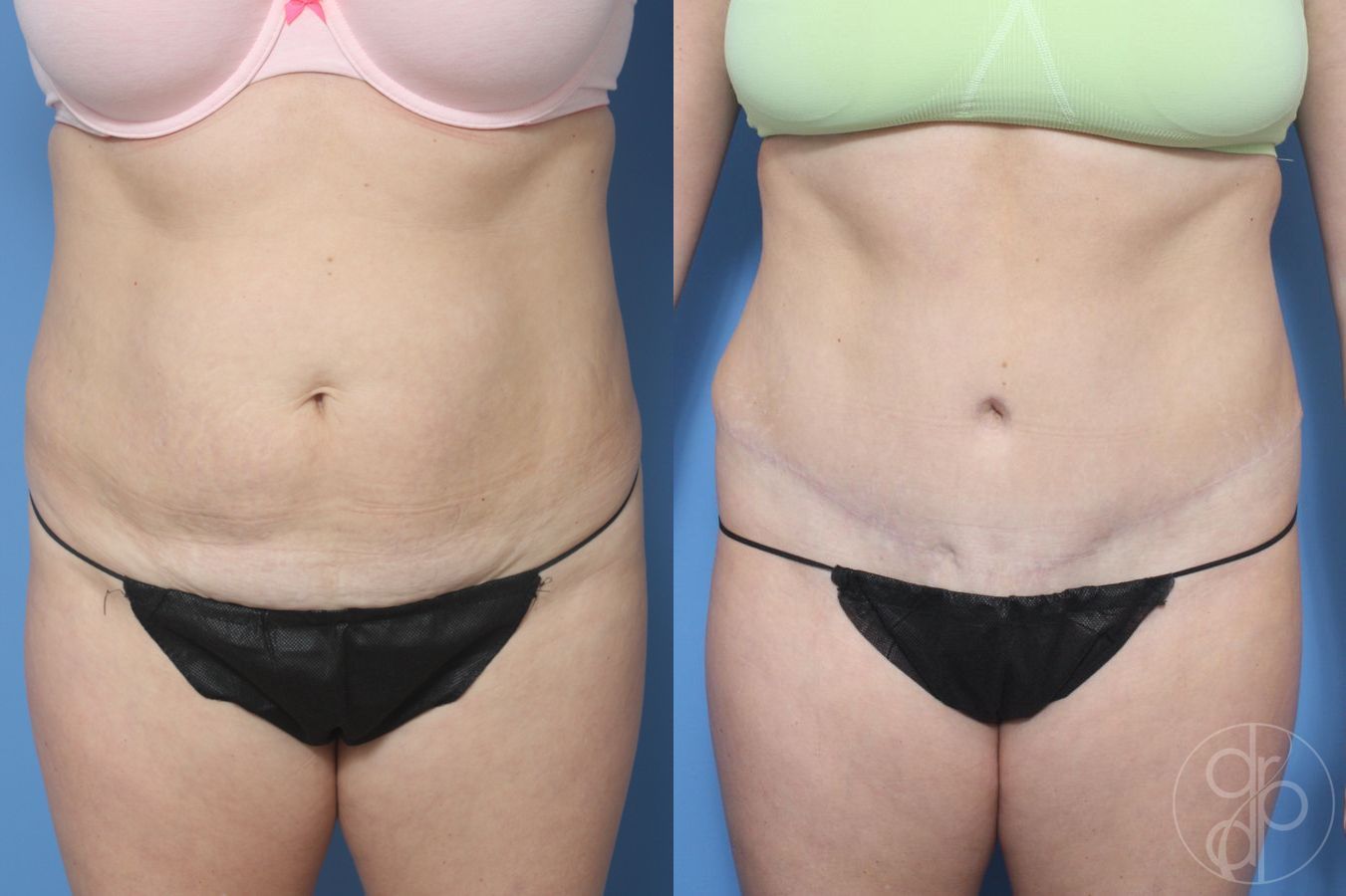 Before and after Abdominoplasty case 29533