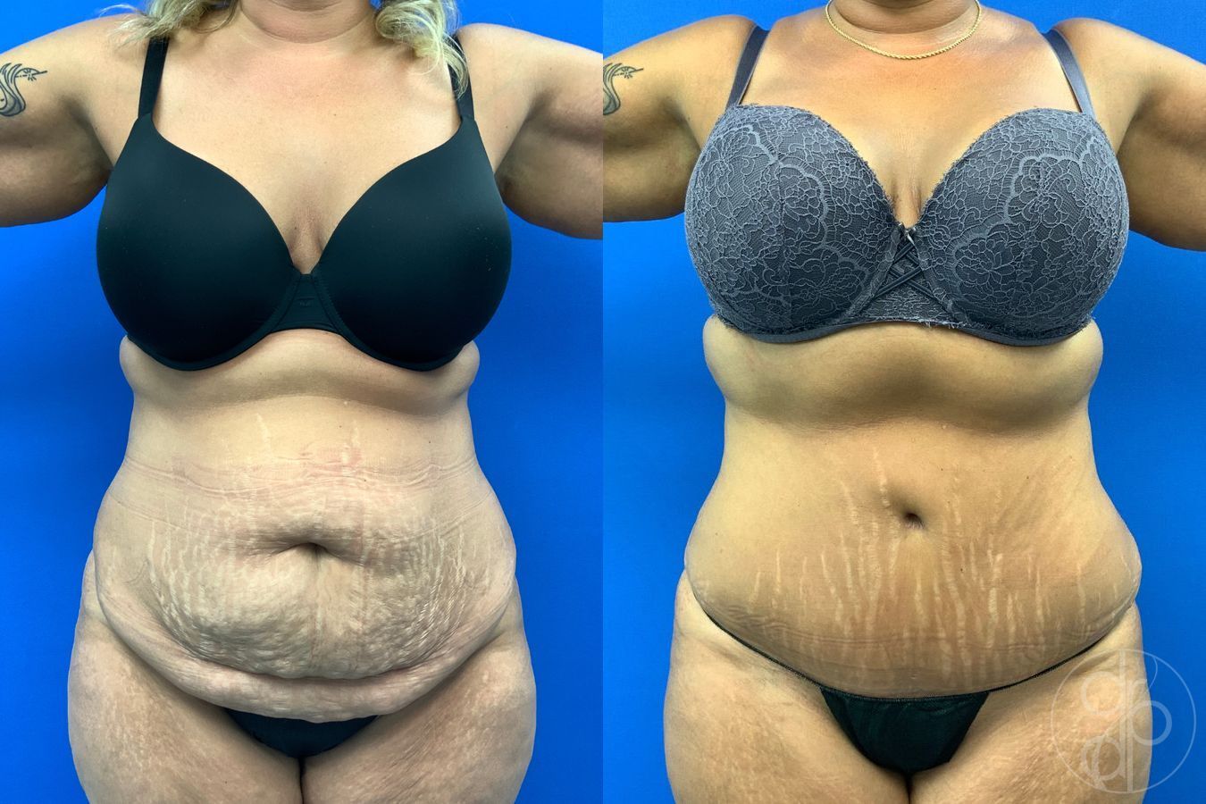 Before and after Abdominoplasty case 43473 - Angle 2