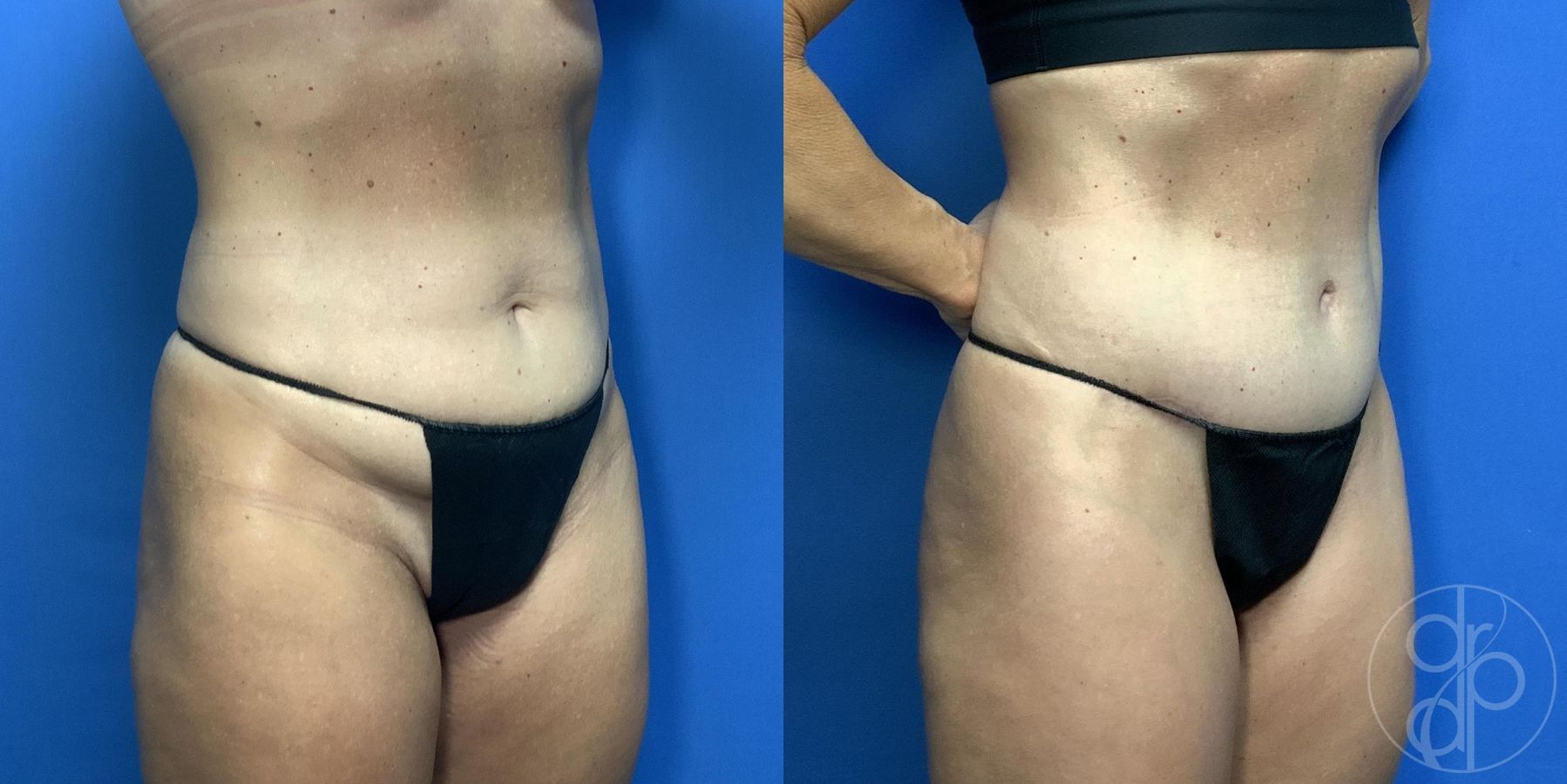 Before and after Abdominoplasty case 29994 - Angle 3