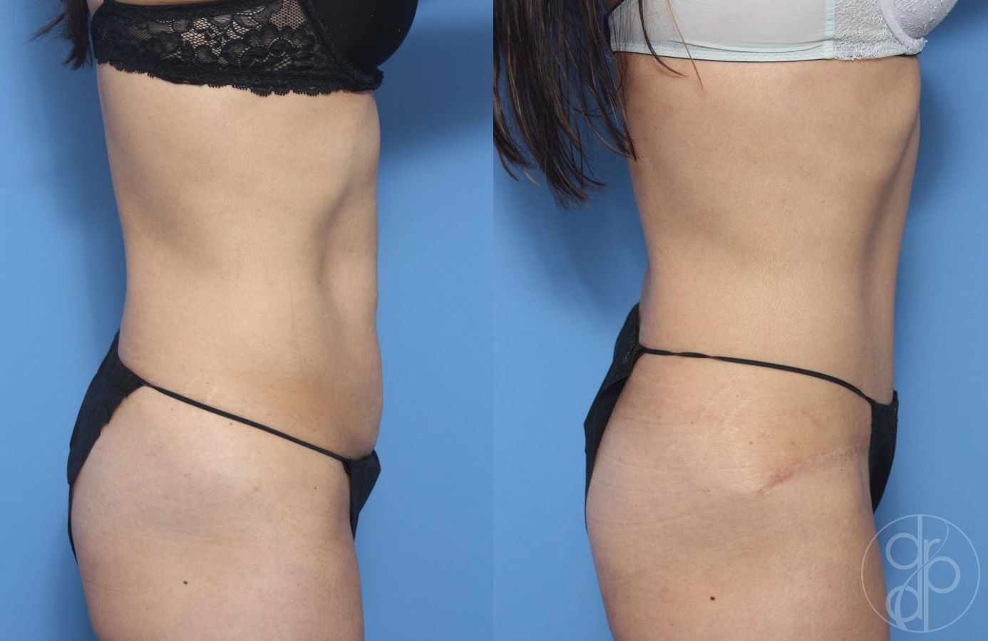 Before and after Abdominoplasty case 29524 - Angle 2