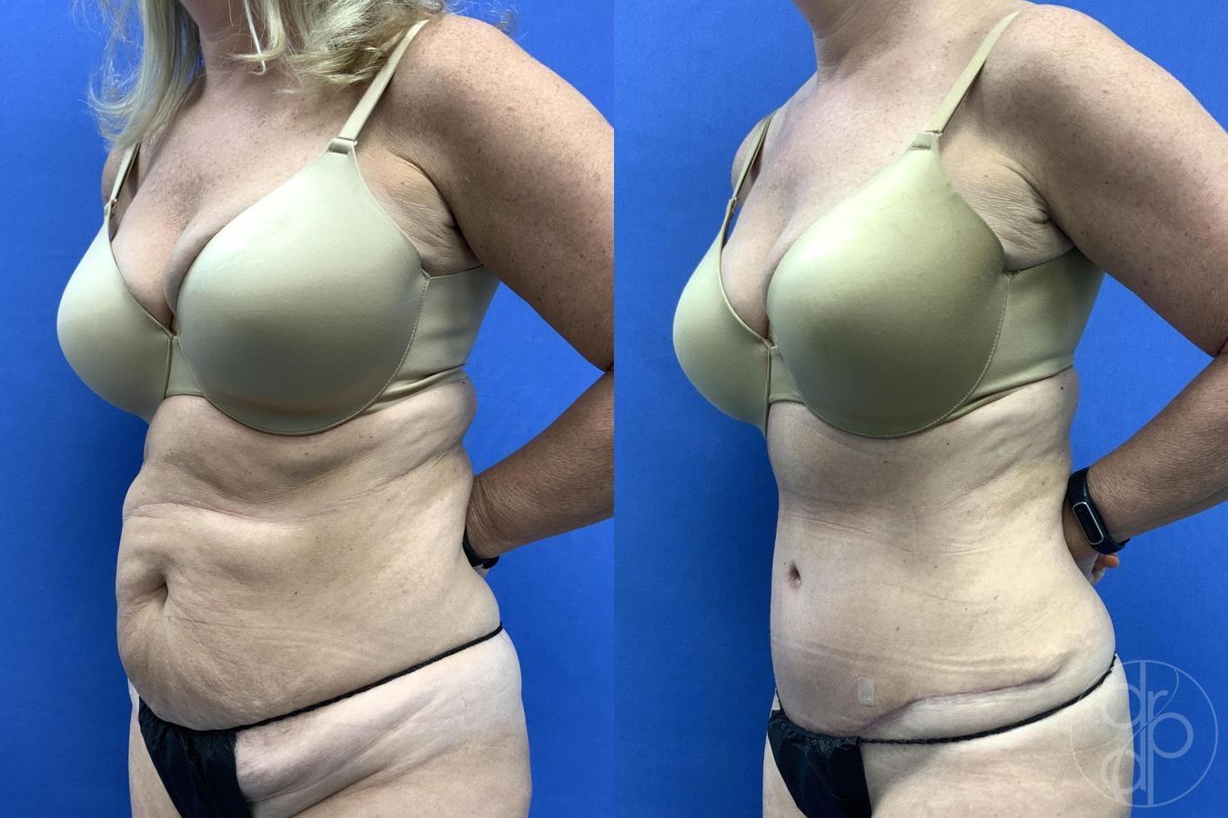 Before and after Abdominoplasty case 29654 - Angle 3