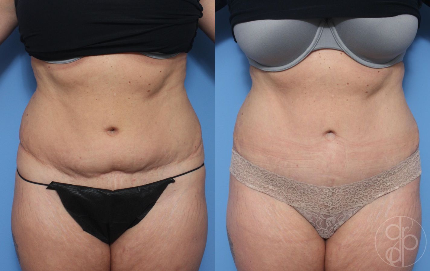 Before and after Abdominoplasty case 29550
