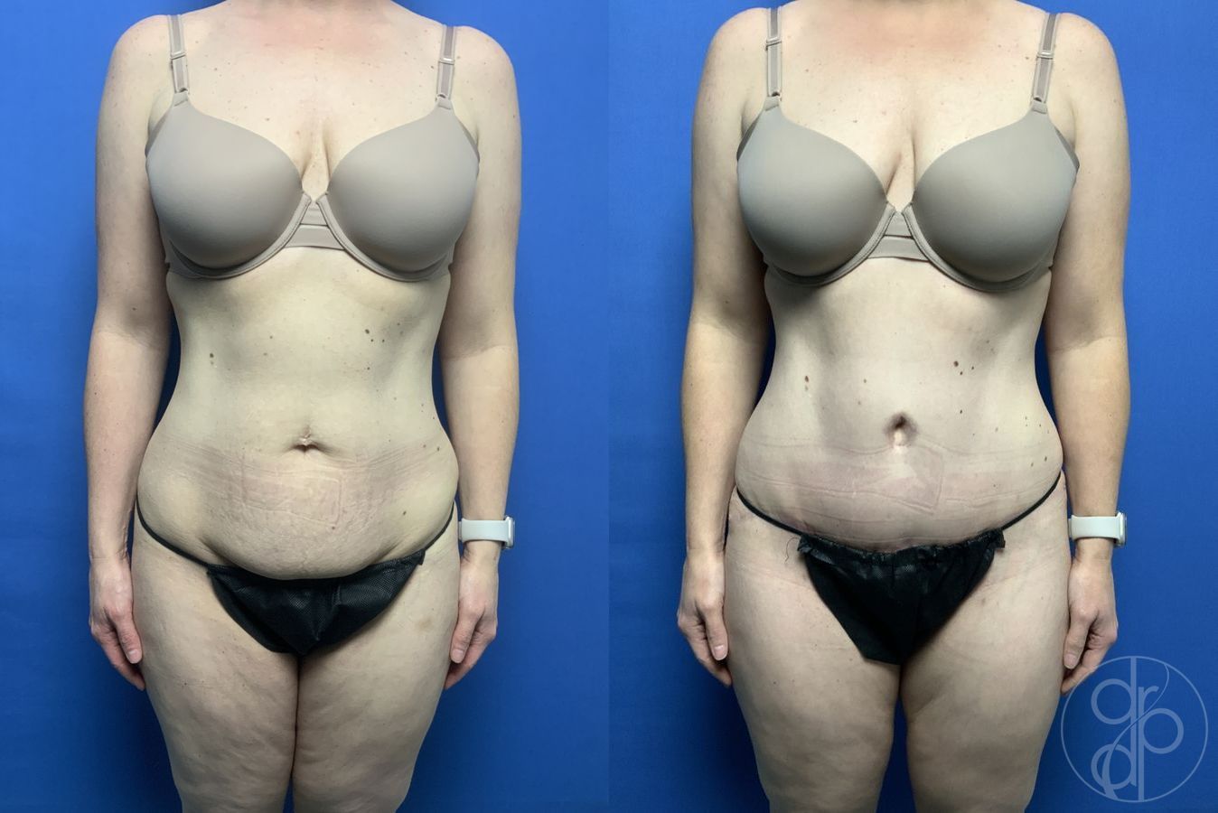 Abdominoplasty - Case 272