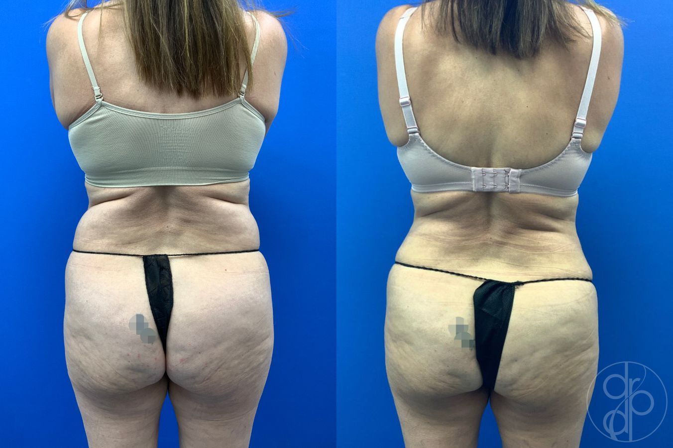 Before and after Abdominoplasty case 46404 - Angle 6
