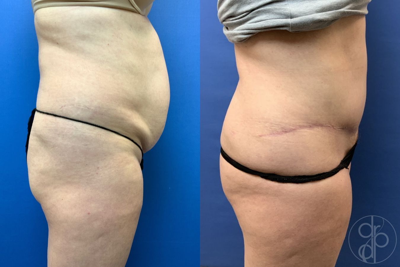 Before and after Abdominoplasty case 29579 - Angle 3