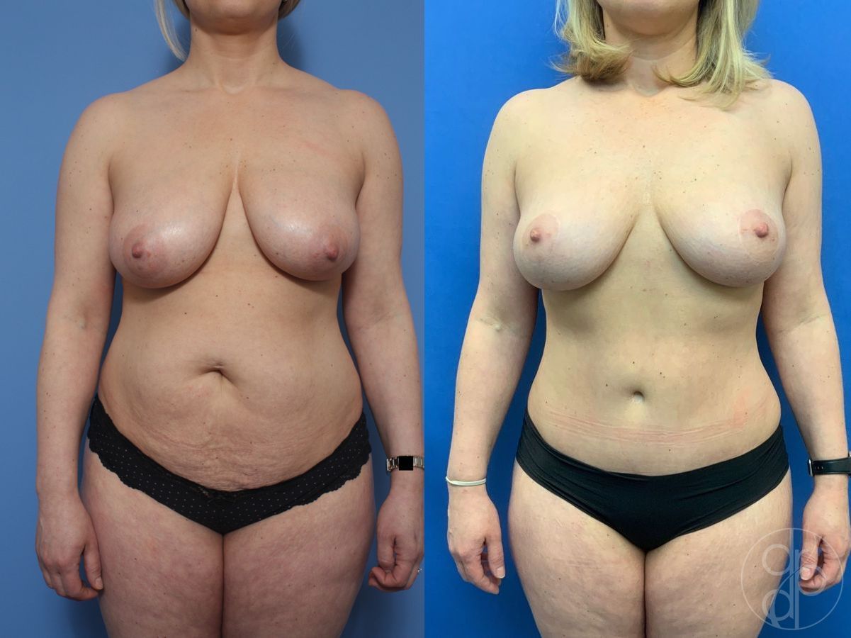 Before and after Abdominoplasty case 29668