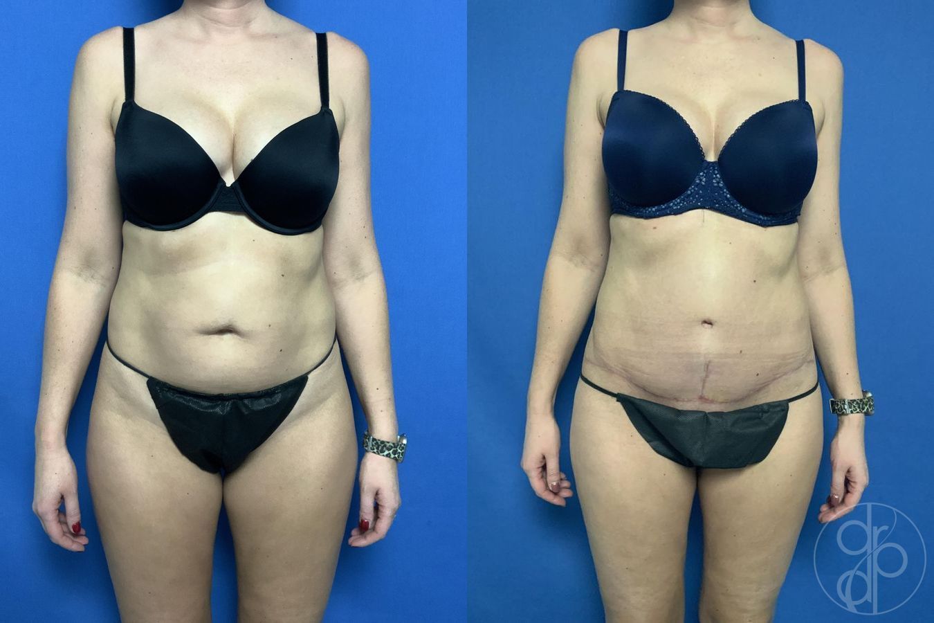 Abdominoplasty - Case 284