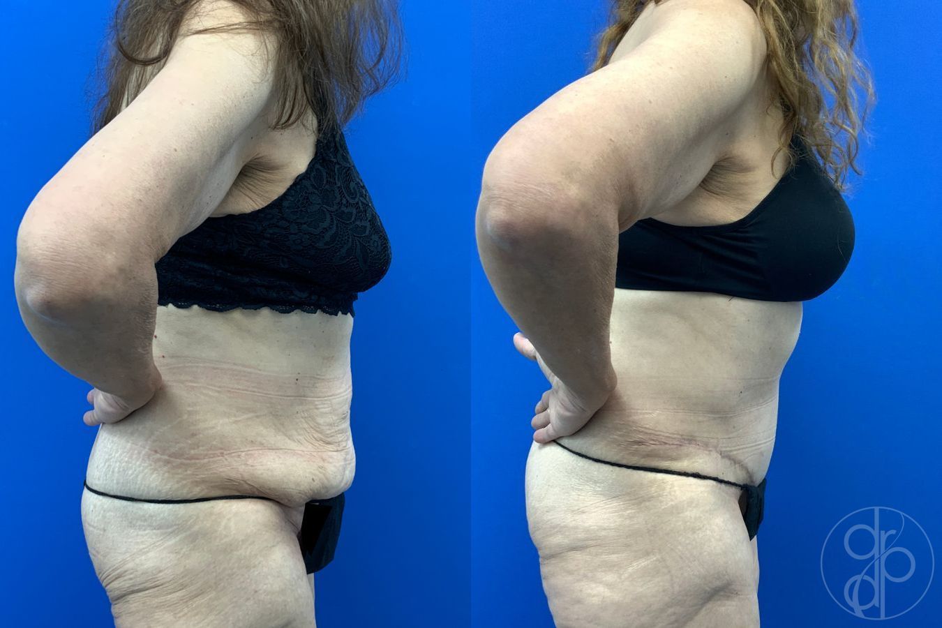 Before and after Abdominoplasty case 43198 - Angle 6