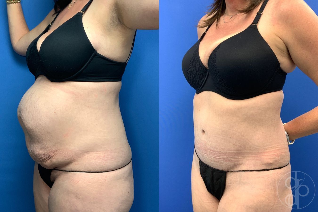 Before and after Abdominoplasty case 43192 - Angle 3