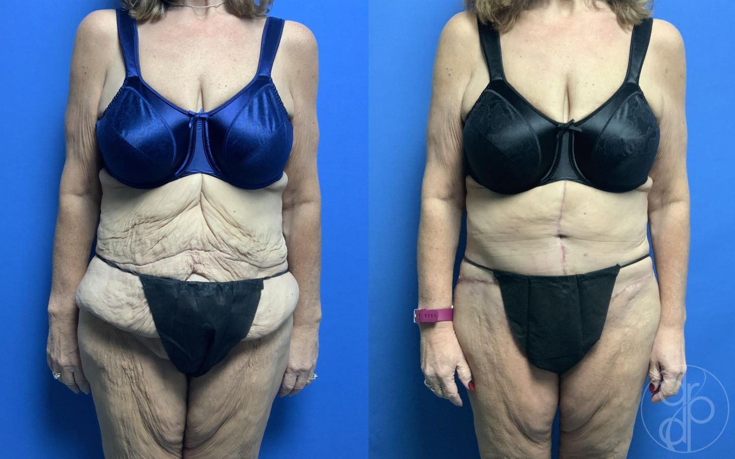 Abdominoplasty - Case 287