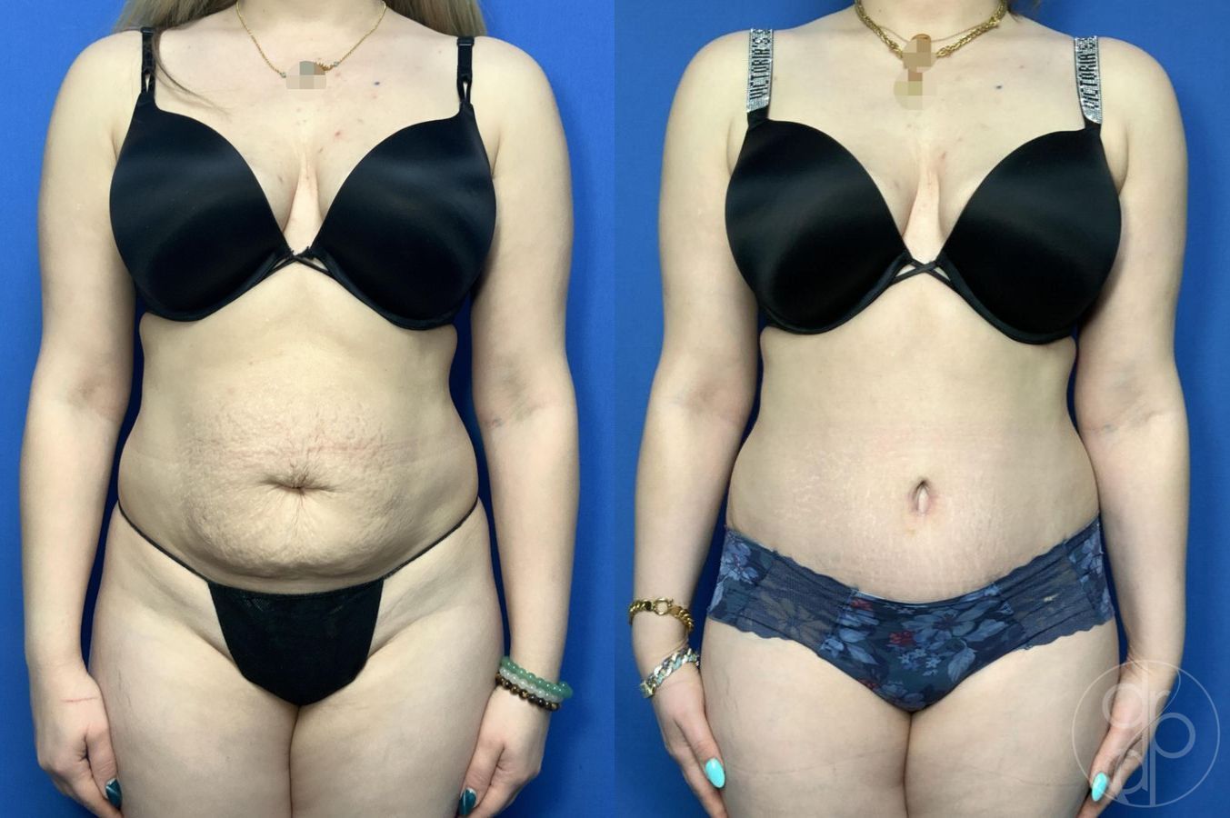 Before and after Abdominoplasty case 30006