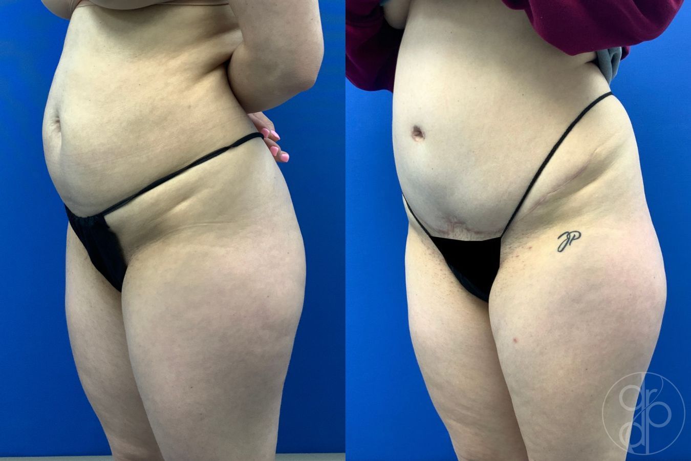 Before and after Abdominoplasty case 43481 - Angle 3