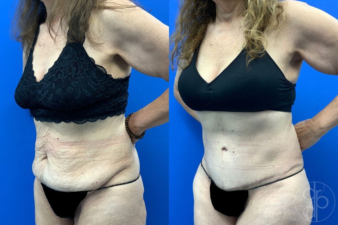 Before and after Abdominoplasty case 43198 - Angle 3