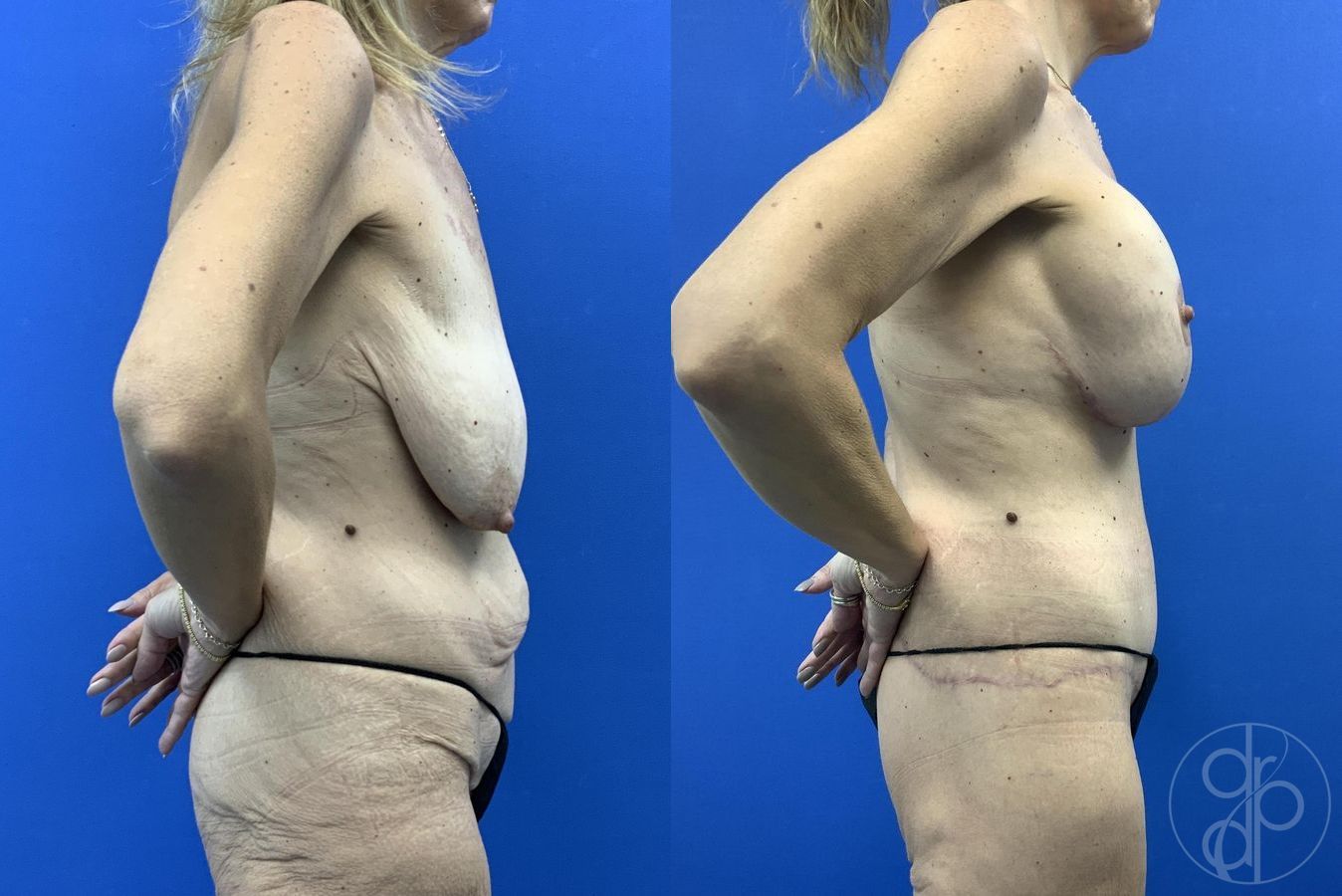Before and after Abdominoplasty case 29983 - Angle 5