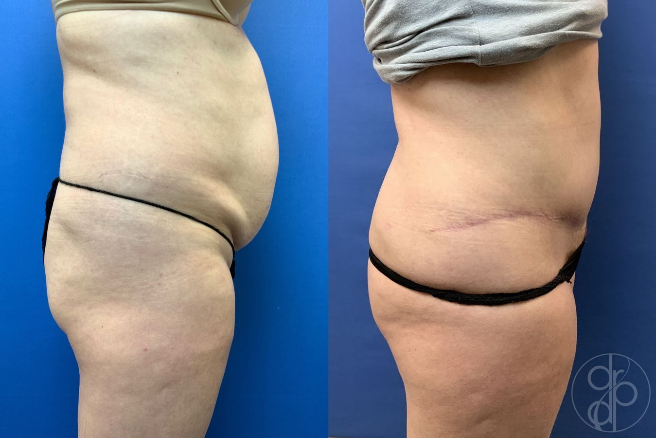 Before and after Abdominoplasty case 29579 - Angle 3