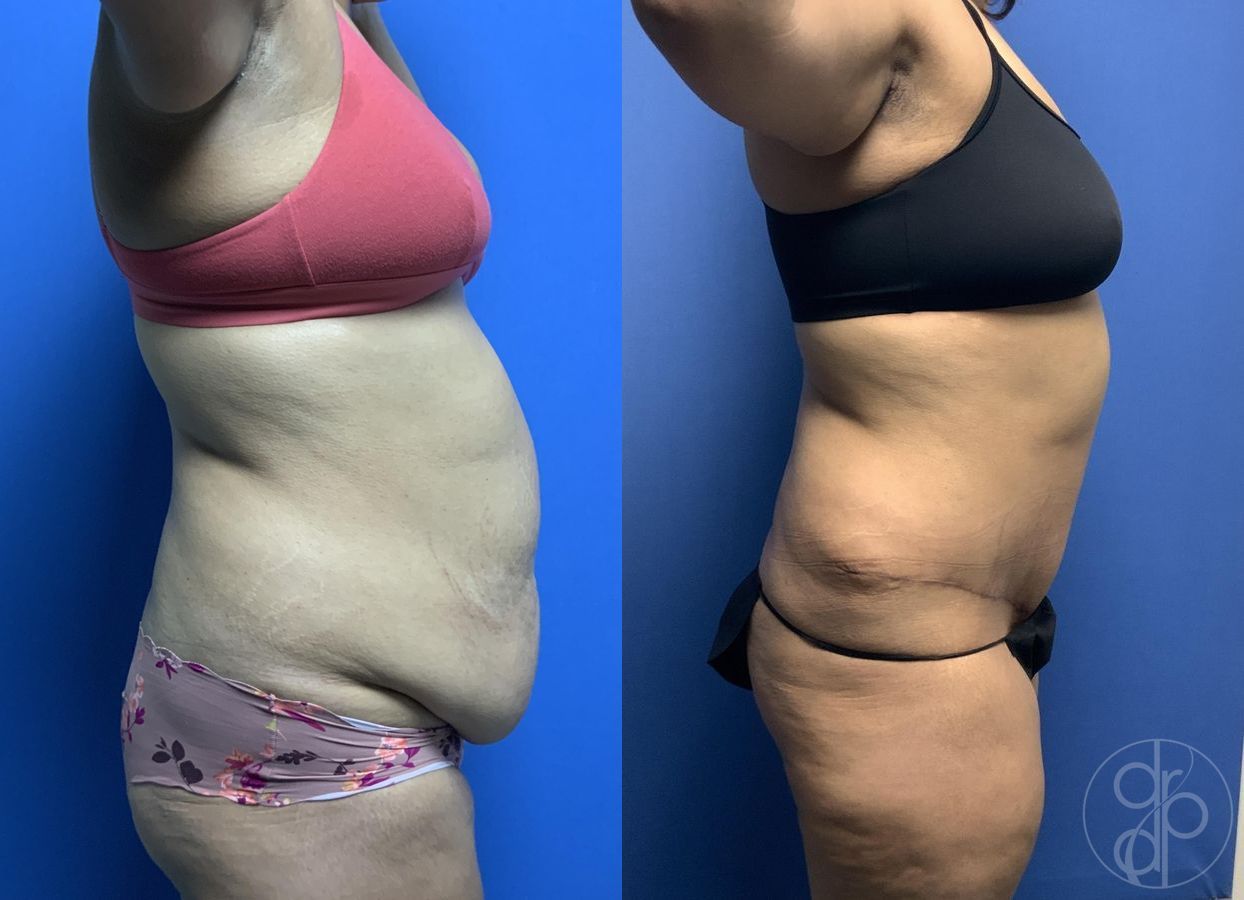Before and after Abdominoplasty case 29566 - Angle 2