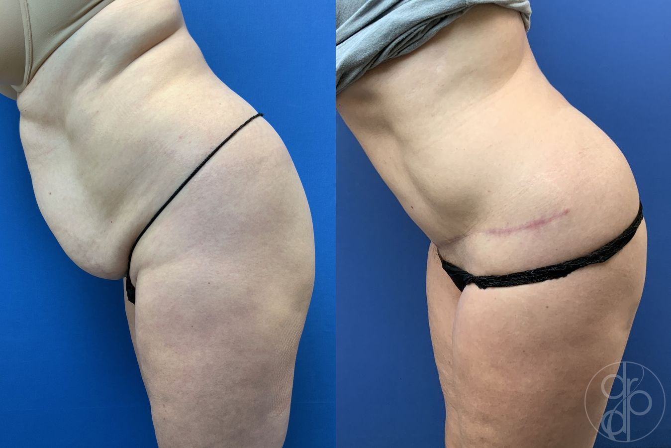 Before and after Abdominoplasty case 29579 - Angle 2