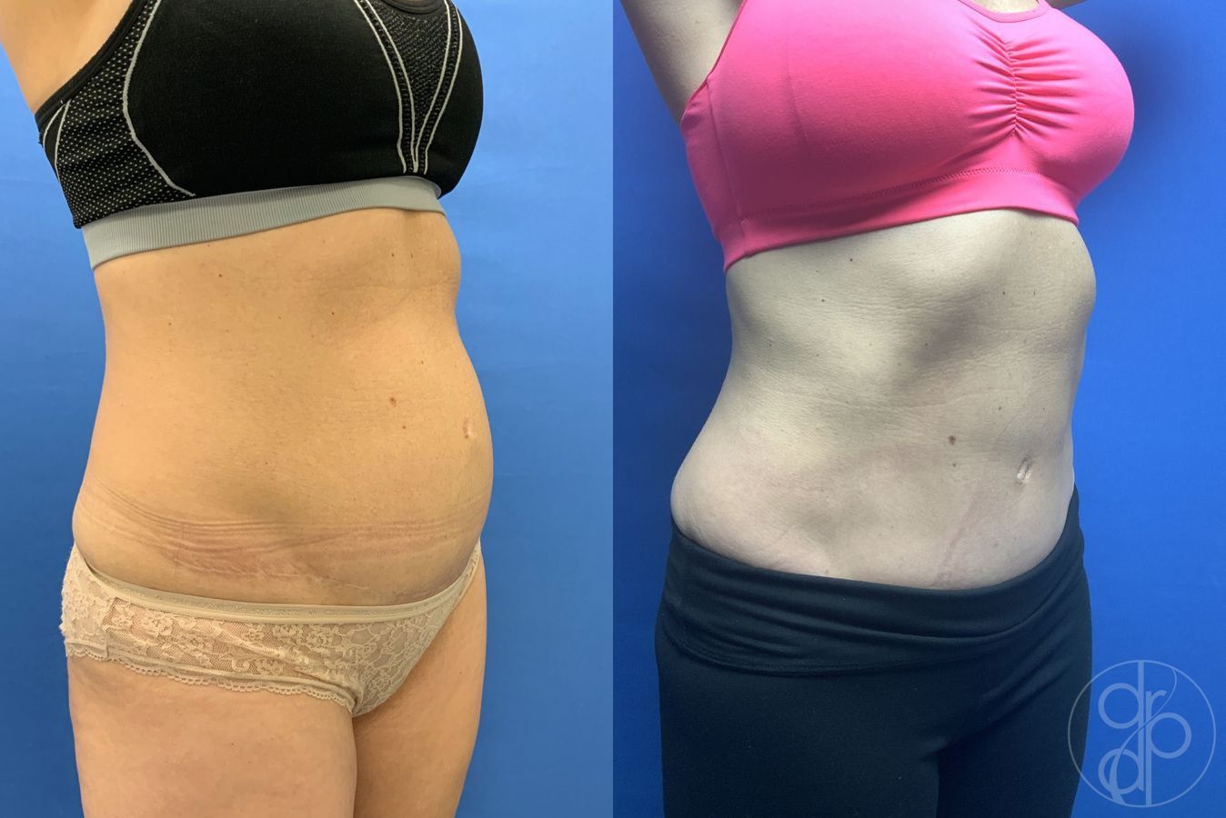 Before and after Abdominoplasty case 29572 - Angle 2