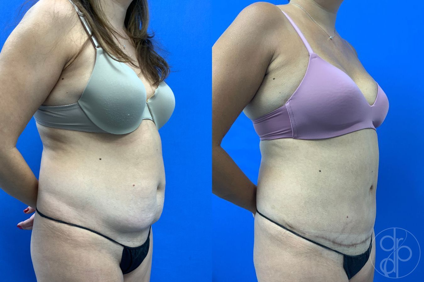 Before and after Abdominoplasty case 43451 - Angle 4