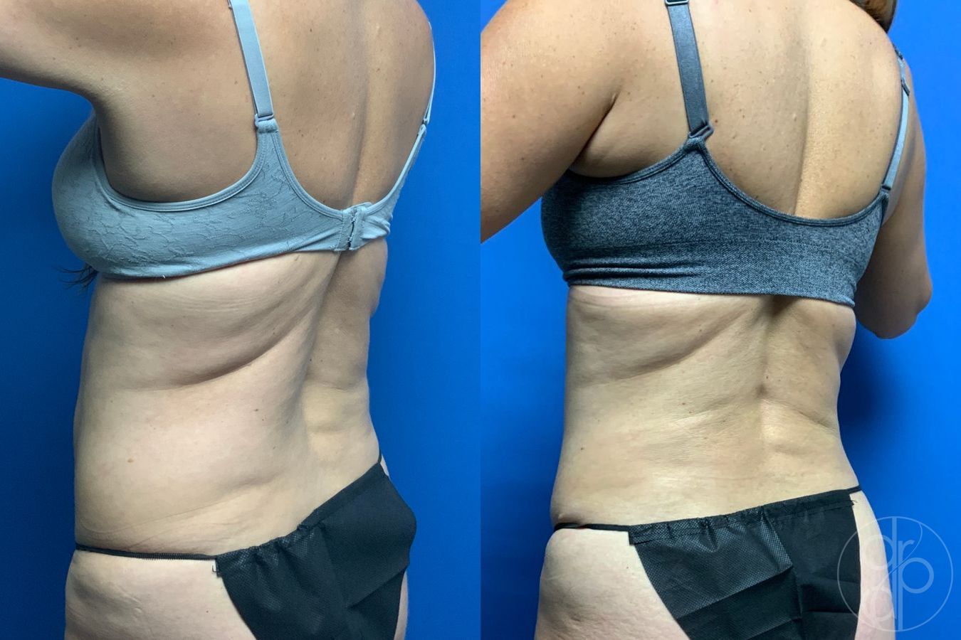 Before and after Liposuction case 46422 - Angle 4