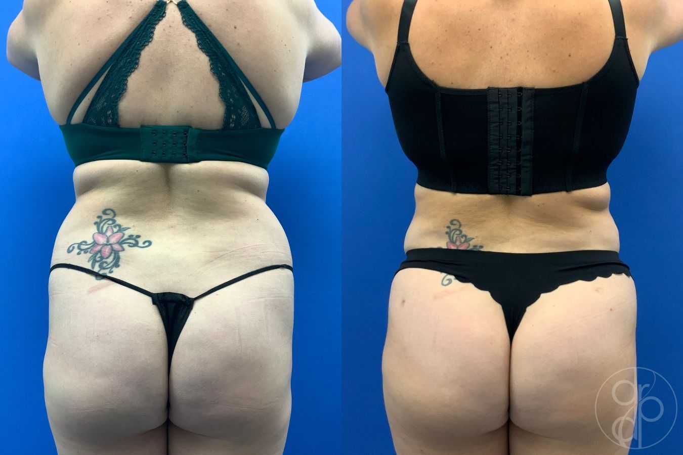 Before and after Liposuction case 43486 - Angle 5