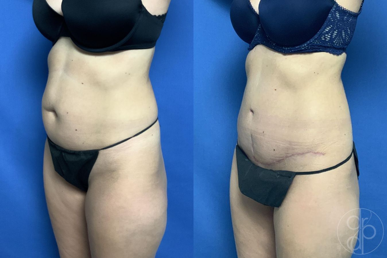 Before and after Abdominoplasty case 29573 - Angle 3