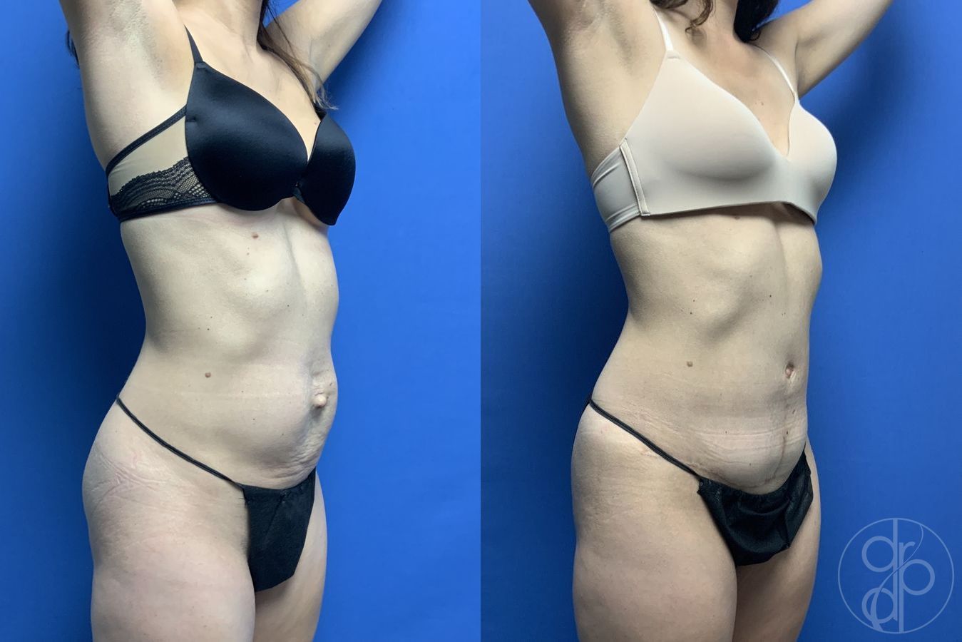 Before and after Abdominoplasty case 29567 - Angle 3