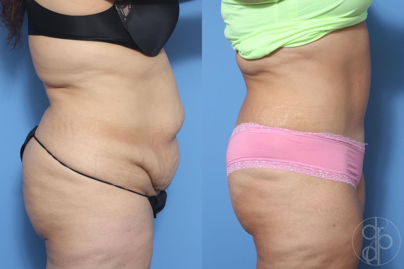 Before and after Abdominoplasty case 29532 - Angle 2