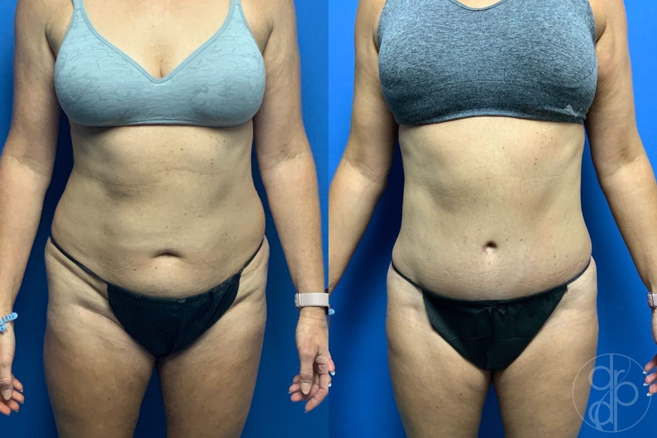 Before and after Liposuction case 46422