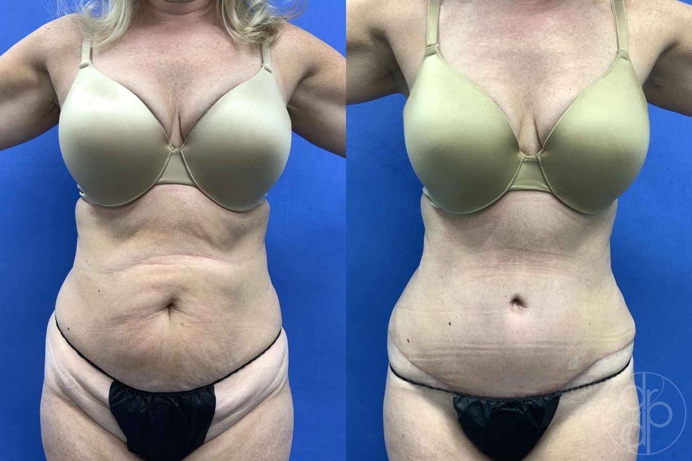Before and after Abdominoplasty case 29654 - Angle 2