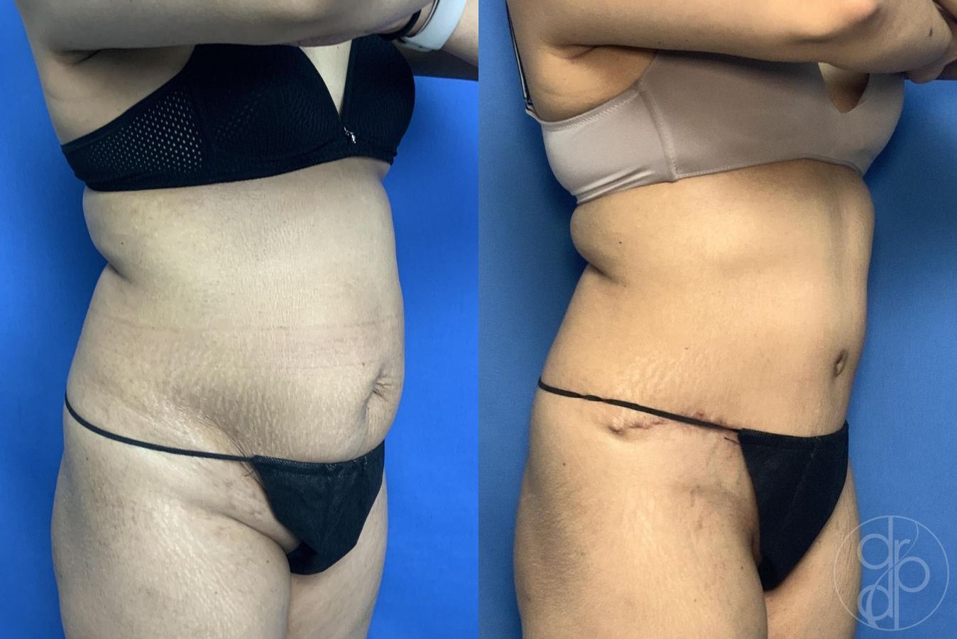 Before and after Abdominoplasty case 29583 - Angle 3