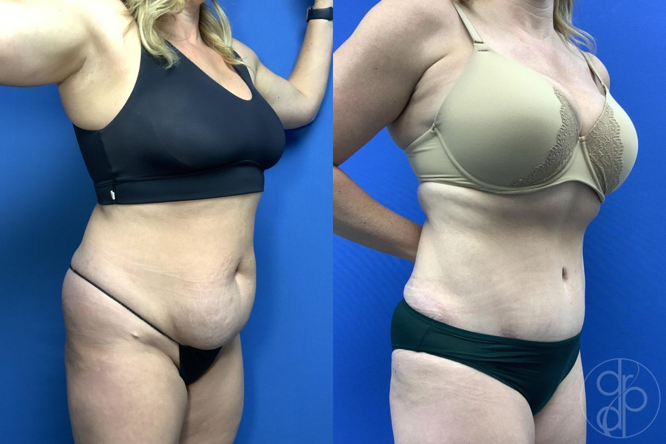 Before and after Abdominoplasty case 29762 - Angle 3