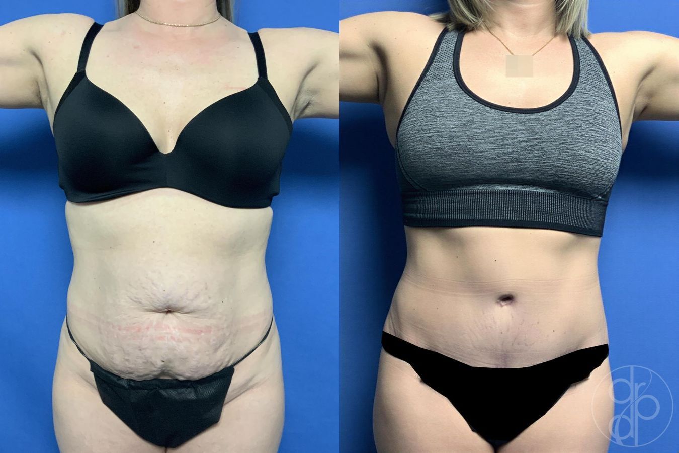 Before and after Abdominoplasty case 29563