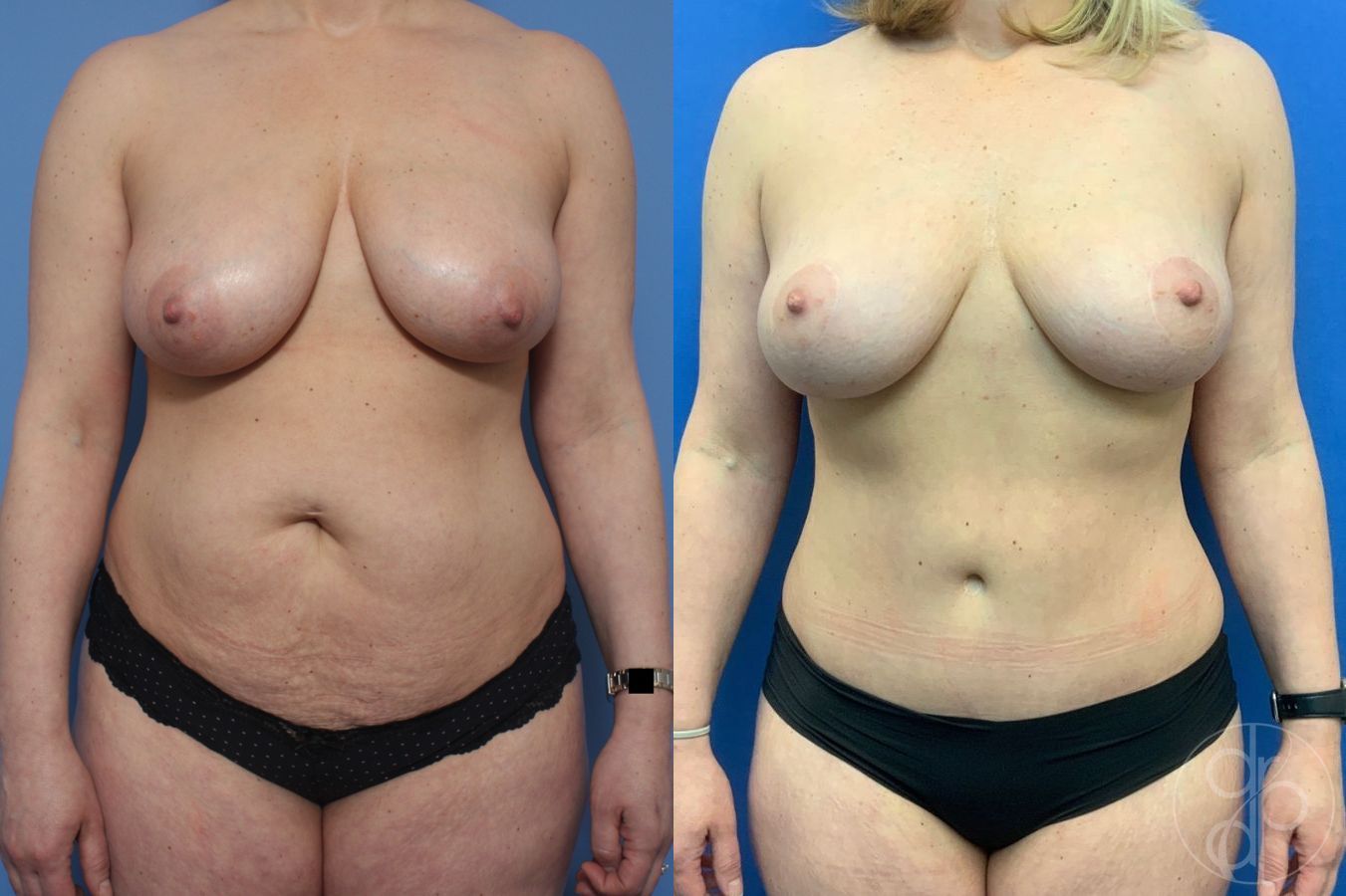 Before and after Breast Reduction case 29668
