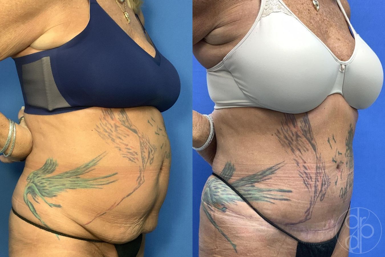Before and after Abdominoplasty case 30022 - Angle 3
