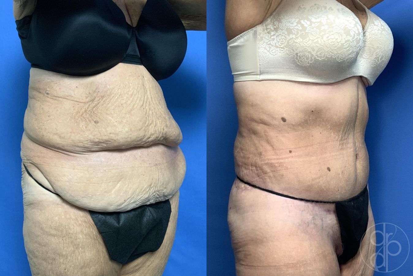 Before and after Abdominoplasty case 29620 - Angle 7