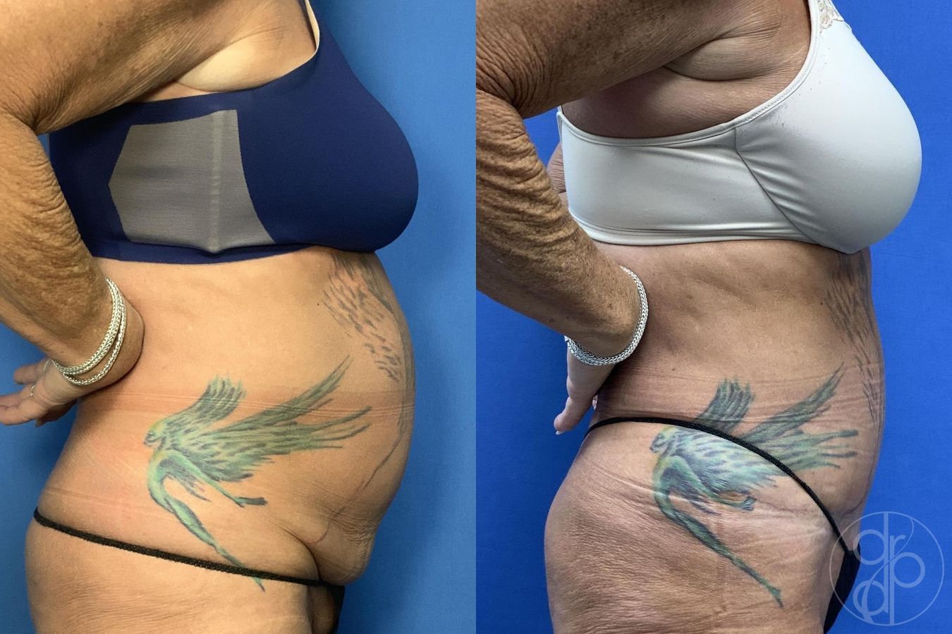 Before and after Abdominoplasty case 30022 - Angle 4
