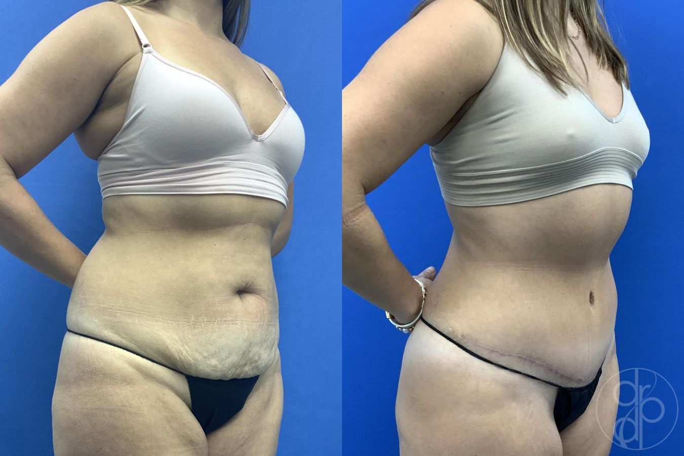 Before and after Liposuction case 30025 - Angle 4