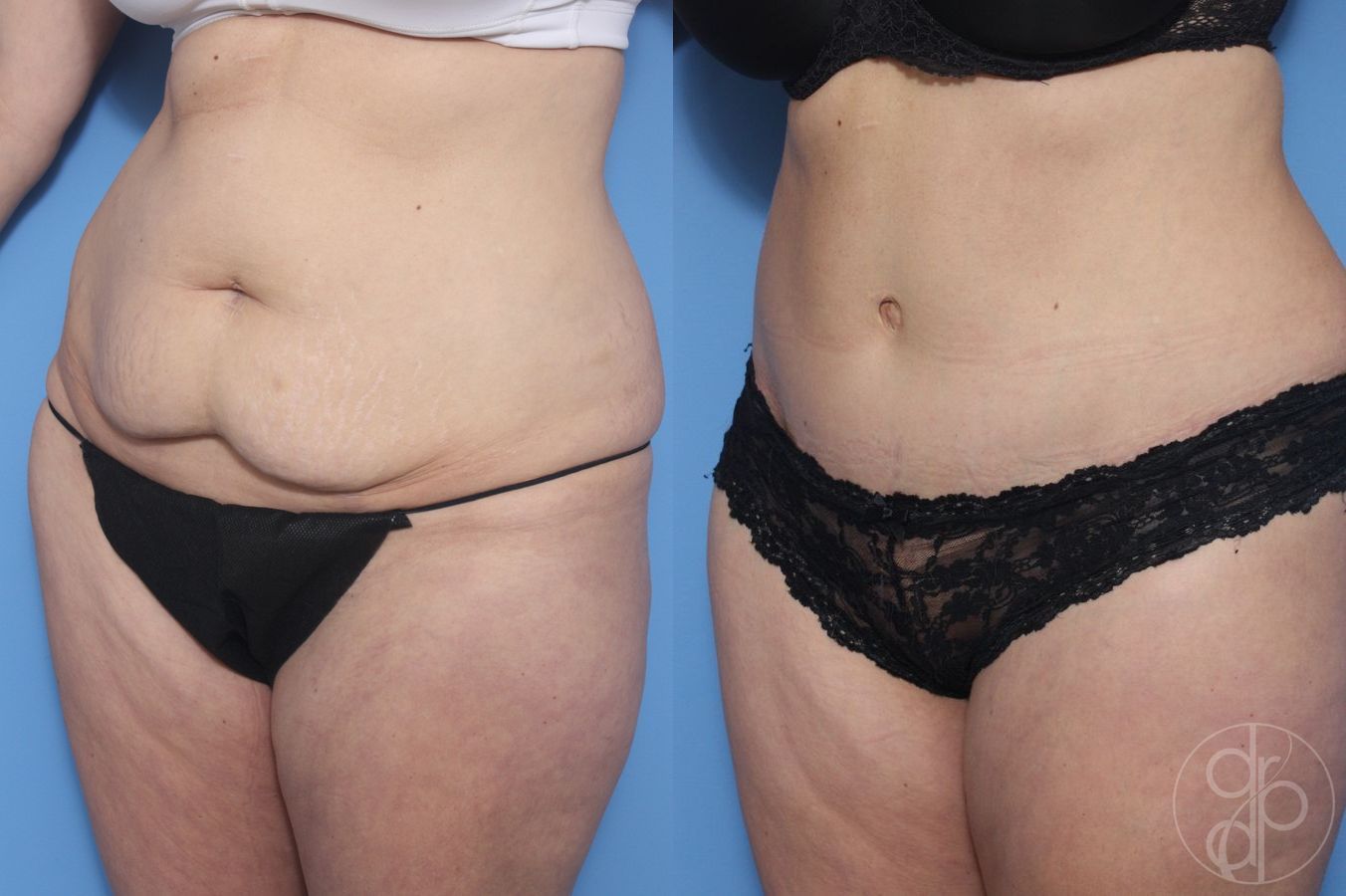 Before and after Abdominoplasty case 29536 - Angle 3