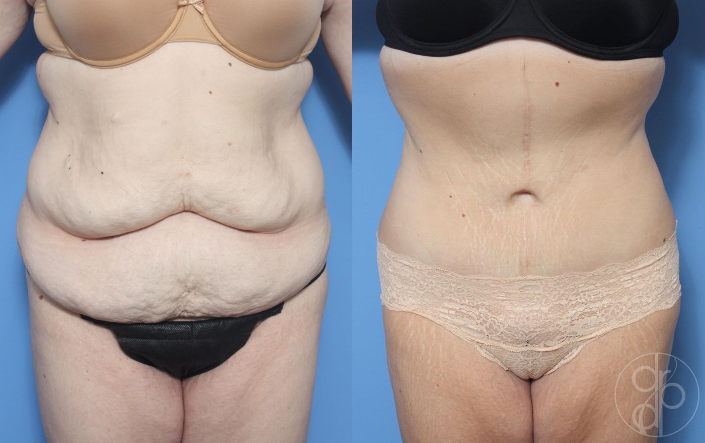 Before and after Abdominoplasty case 29544