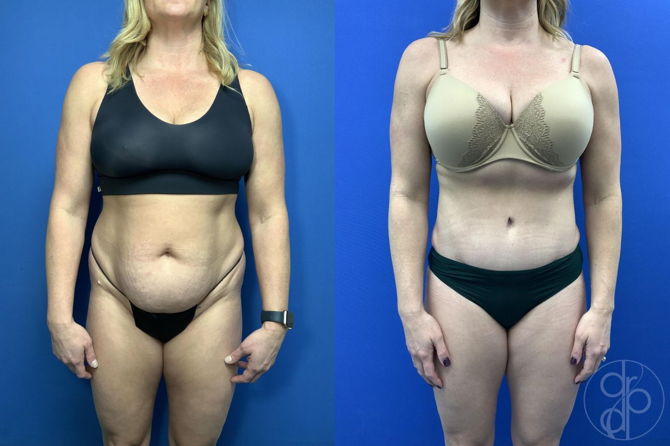 Before and after Abdominoplasty case 29762