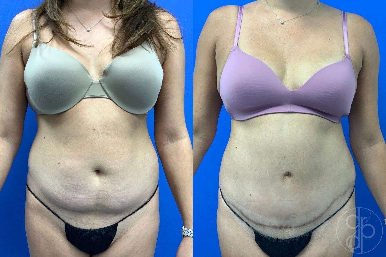 Before and after Abdominoplasty case 43451